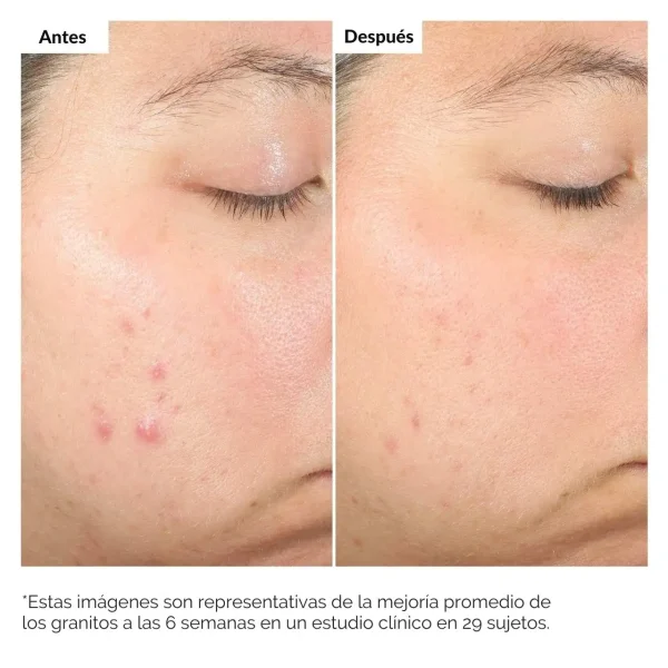 The Ordinary Salicylic Acid 2% | Solución Anti Acné - Imagen 3